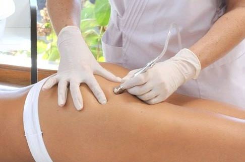 Microdermoabrasión para estrías